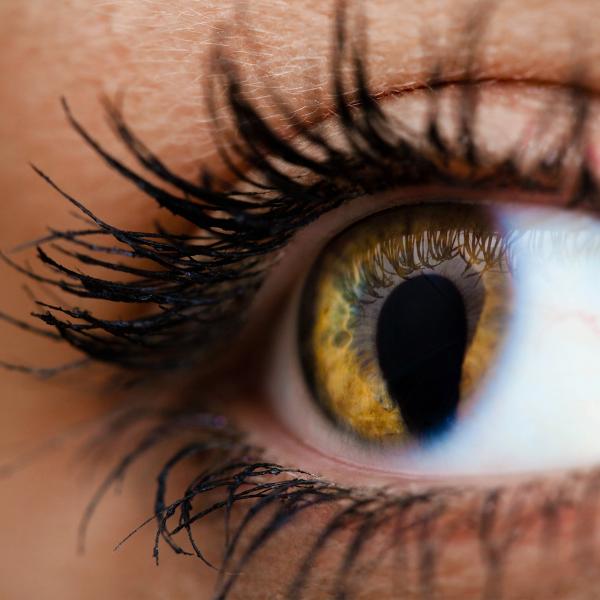 Close-up of an eye with coloboma.