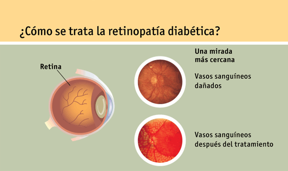 Página 10: ¿Cómo se trata la retinopatía diabética?