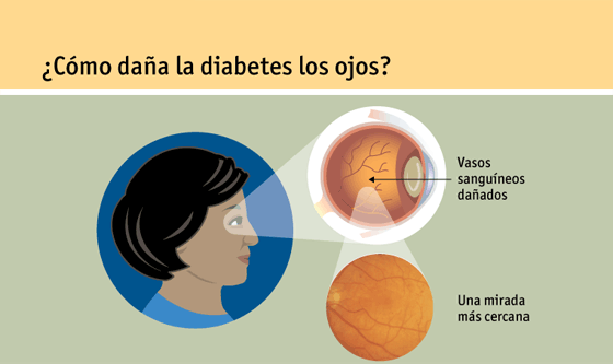 Página 5: ¿Cómo daña la diabetes los ojos?