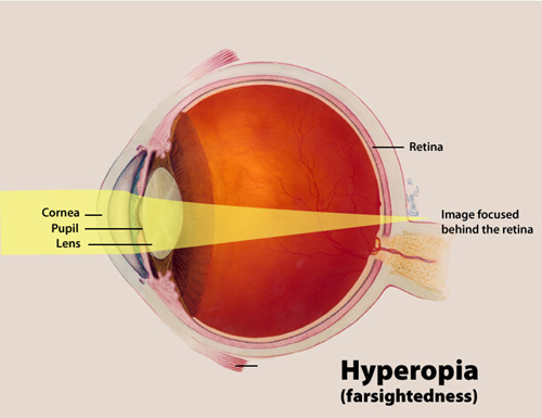 A color illustration of hyperopia highlighting the cornea, pupil and lens, and the way an image focuses behind the retina.