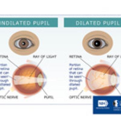 Illustration of the undilated and dilated pupil, showing how much of the retina can be seen.