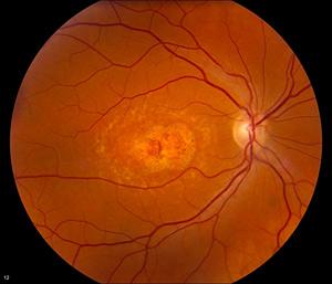 Retina with macular scar