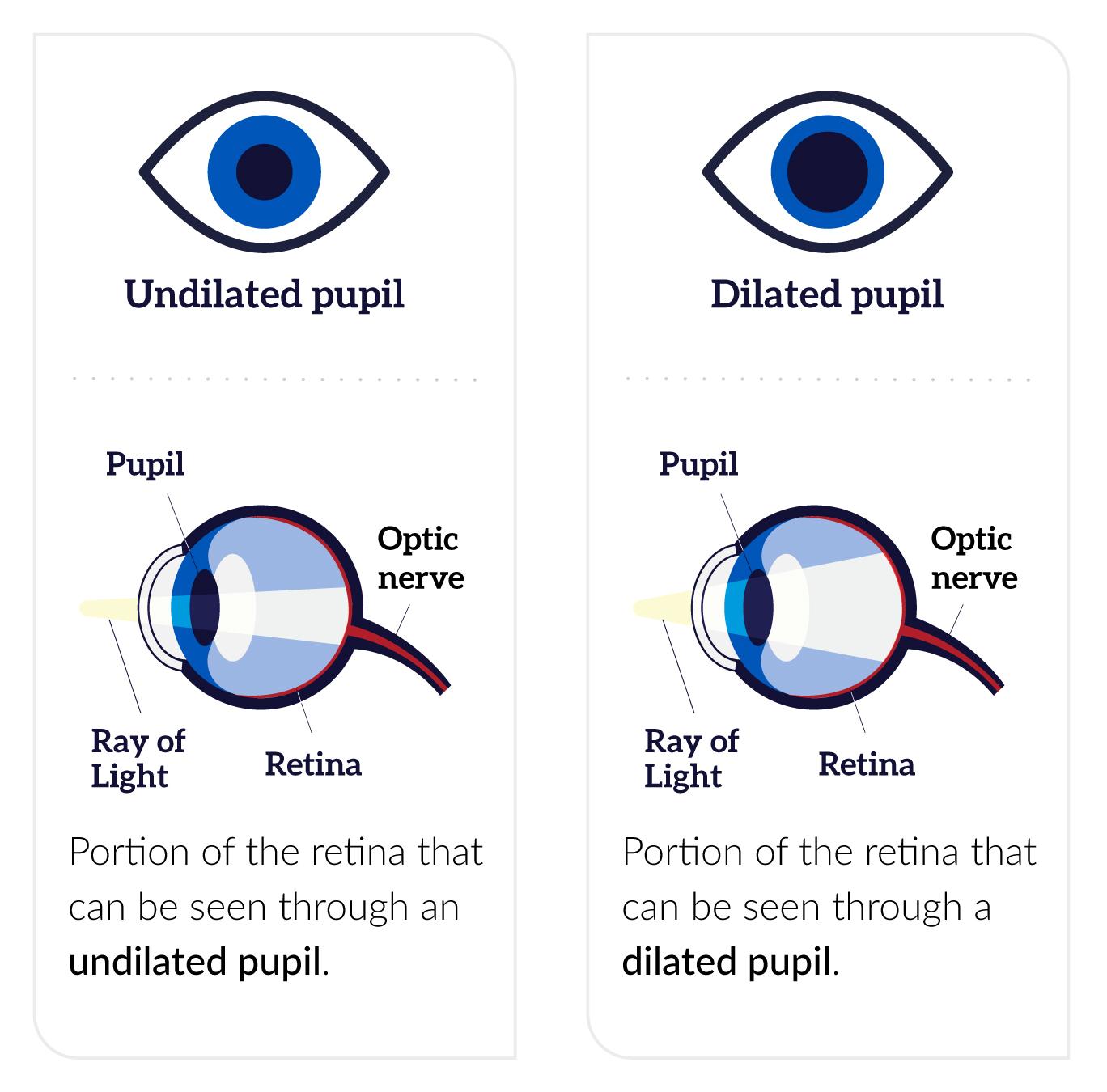 An undilated pupil and a dilated pupil. A narrow ray of light enters the eye through the undilated pupil and shines on a small part of the retina at the back of the eye. A wider ray of light enters through the dilated pupil and shines on a larger part of the retina.