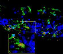 Microglia in retinal sections of a patient with retinitis pigmentosa