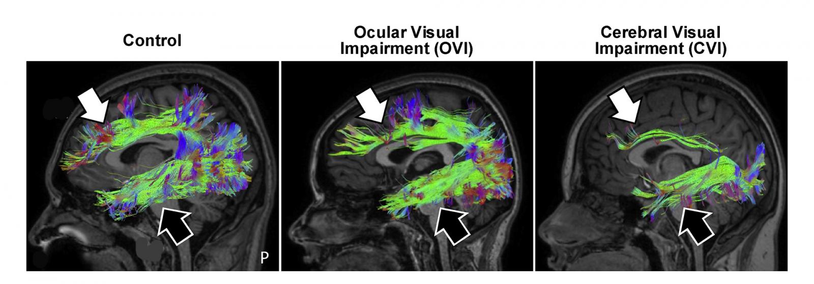 Three side-on cross-section of fMRI brain imaging with neural connections in color