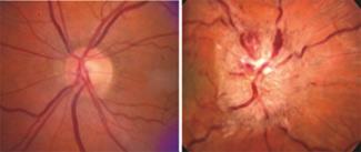 On the left is a normal optic nerve (light circle at center) and on the right is the optic nerve swelling seen in IIH. Courtesy of Dr. Michael Wall, University of Iowa.