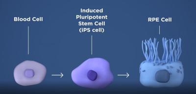 Labeled diagram of a blood cell, iPS cell and RPE cell with arrows pointing right between each cell. 