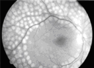 Imagen de la retina inmediatamente después del tratamiento focal con láser