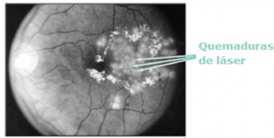 La retina inmediatamente después del tratamiento focal con láser