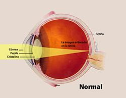 La córnea y el cristalino desvían (refractan) los rayos de luz que vienen entrando para que se enfoquen con precisión sobre la retina en la parte posterior del ojo.