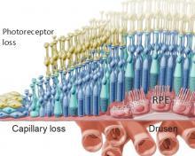 Diagram of RPE cell loss