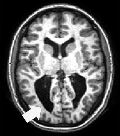 Cross-section of fMRI brain scan with arrow pointing to dark area