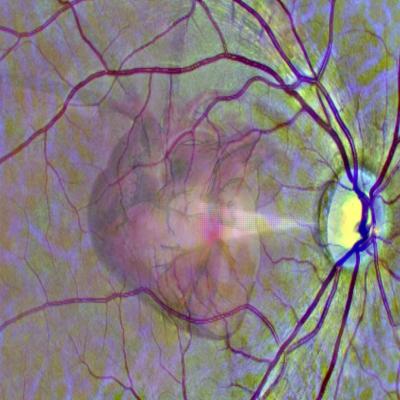Image of a heart superimposed over a retinal image