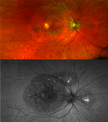 Two images, red and black, showing dark circles indicative of eye disease