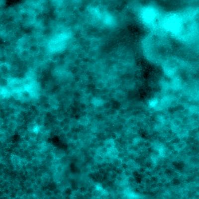 Disrupted retinal pigment epithelial cells visualized using darkfield imaging in choroideremia.