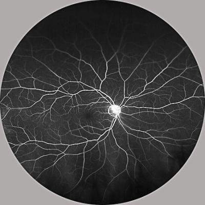 Retinal blood vessels
