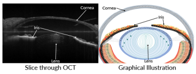 OCT slice, graphical illustration showing newt lens and iris.