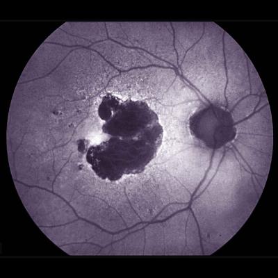 Photo of retina with large dark splotch to left of optic nerve.