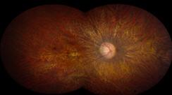 LCA is an inherited disorder that causes vision loss in childhood. It primarily affects the functioning of the retina, the light-sensitive tissue at the back of the eye, as shown here. Photo credit: National Eye Institute