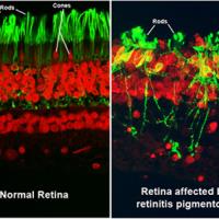 The image on the left is labeled "Normal retina," and shows green rods and red cones. The image on the right is labeled "Retina affected by retinitis pigmentosa," and shows green rods that have broken down.