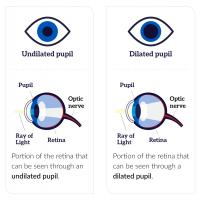 An undilated pupil and a dilated pupil. A narrow ray of light enters the eye through the undilated pupil and shines on a small part of the retina at the back of the eye. A wider ray of light enters through the dilated pupil and shines on a larger part of the retina.