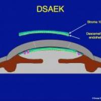 DSAEK Corneal transplantation
