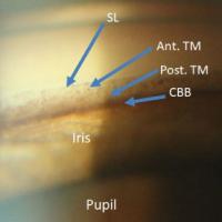 Trabecular meshwork