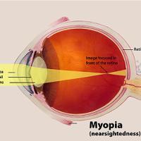 Diagram of myopic eye stretched front-to-back showing light focused in front of the retina