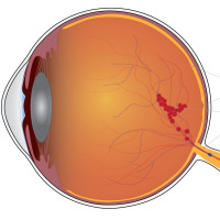Schematic shows blood vessel leakage on side of retina