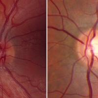 Comparison of two retinal images. 
