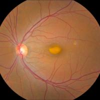 Image of retina