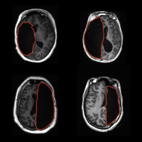 Top-down sectional views of 4 brain scans, showing missing hemispheres.