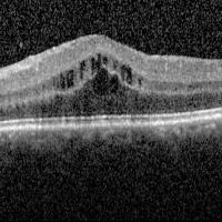 Retinal OCT showing fluid pocket in the macula