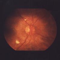 fundus photo showing diabetic retinopathy