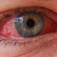Bloodshot eye