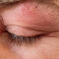 shingles eye