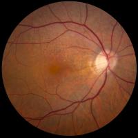 A fundus photo of a patient with reticular pseudodrusen shows a giraffe-like macular pattern.