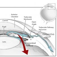 Aqueous humor flows out of the anterior chamber through the open angle where the cornea meets the iris. The open angle consists of two routes: the conventional, trabecular pathway, which includes a spongy layer called the trabecular meshwork, and the non-conventional, uveoscleral pathway, through the ciliary muscle that controls the eye’s focusing mechanism. The majority of fluid flows out via the trabecular pathway, which acts like a one-way valve. About a third of the fluid exits through the uveoscleral p