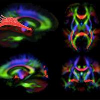 Images of the brain generated by diffusion tensor imaging, a type of MRI. The red highlights show visual pathways in the brain that deteriorate in patients with LCA, but appear to improve with gene therapy to the retina. Credit: Dr. Manzar Ashtari, University of Pennsylvania.