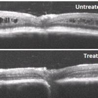 Cross-sectional images of retina from retinoschisin-deficient mice, untreated and treated with XLRS gene therapy.