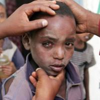 Children who slept near a cooking fire were four times as likely to develop severe trachoma compared with children who slept in ventilated rooms without cooking fires. This child’s severe trachoma led to loss of vision in his left eye. Photo courtesy of Raul Vasquez/Orbis.