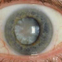 An age-related cataract. Credit: National Eye Institute.